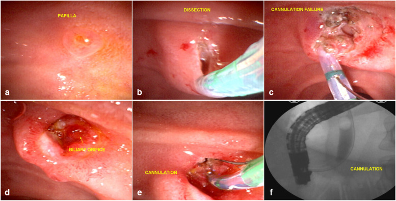 Failed EFP in the first attempt. a small papilla and failed cannulation with the sphincterotome and guide wire; b EFP with wide incisions; c failed cannulation after dissection; d 6 days later: the bile duct is easily visualized by staining the bile around the fistula orifice; e cannulation of the bile duct; f deep cannulation and contrast injection