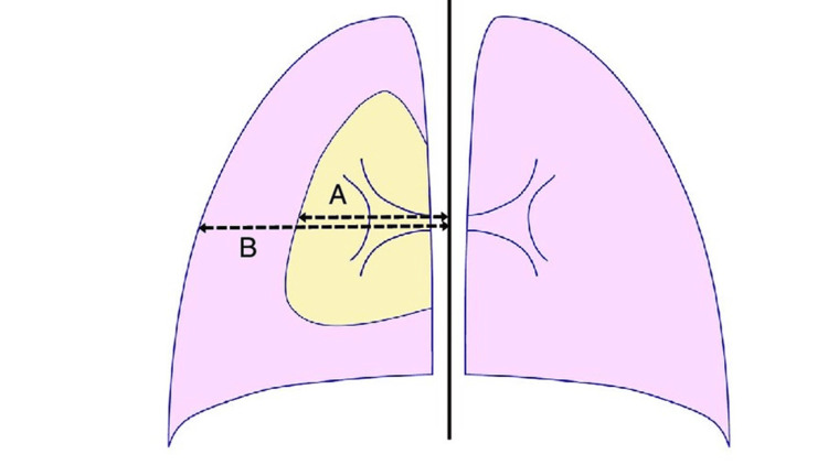 Light's index for estimating the size of pneumothorax. (A) Lung diameter and (B) hemithorax diameter (both measured at the level of pulmonary hilum).Source: [4]