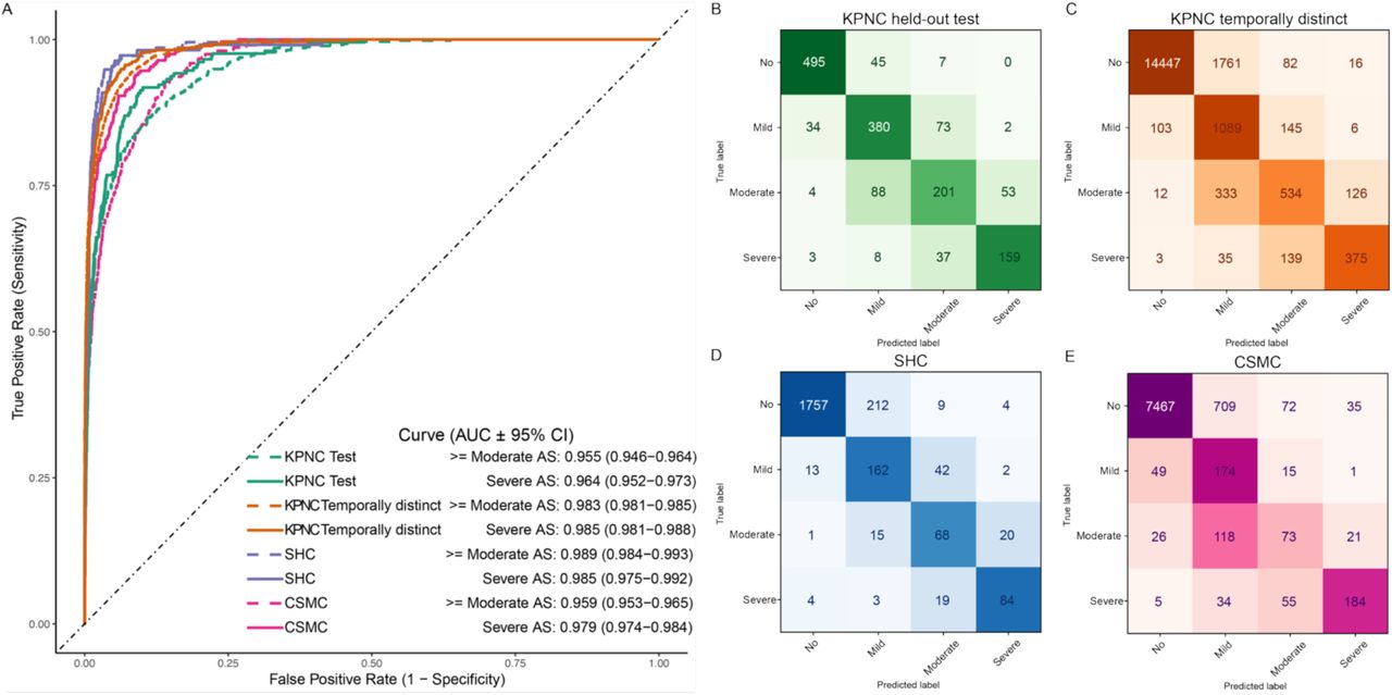 (A) Receiver operating characteristic (ROC) curves for detection of severe or at least moderate aortic stenosis (AS) in Kaiser Permanente Northern California (KPNC) internal test cohort (green), KPNC temporal cohort (orange), Stanford Healthcare (SHC) cohort (purple), and Cedars-Sinai Medical Center (CSMC) cohort (pink). Predictions for severe and at least moderate are shown in solid and dash lines, respectively. (B-E) Confusion matrix of AS severity classification on KPNC test cohort (B), KPNC temporally distinct cohort (C), SHC cohort (D), and CSMC cohort (E) are shown. Confusion matrix colormap values were scaled based on the proportion of actual disease cases in each class that were predicted in each possible disease category. AUC area under the receiver operating characteristic curve; CI, confidence interval.