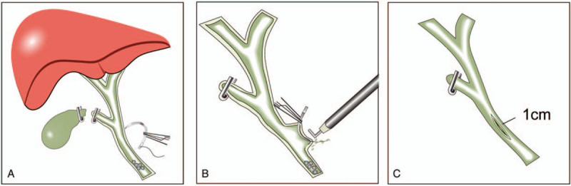 Schematic representation of PDN. (A) A triangular needle was vertically manipulated to puncture the CBD. (B) The triangular needle was longitudinally manipulated avoiding blood vessels. Subsequent yellow bile leak confirmed the CBD structure. The triangular needle was lifted to maintain the CBD under certain amount of tension, and an electric hook was introduced to linearly incise the CBD. (C) A 1-cm long linear incision was made and then prepared for LCBDE.
