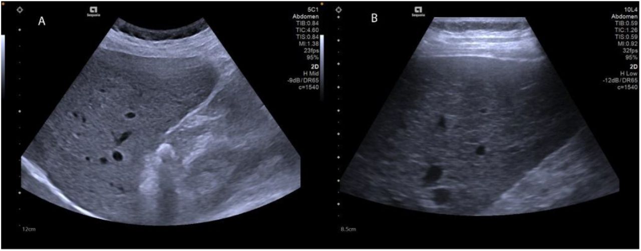 Ultrasound images of a liver from a female participant in her 50’s with HCV(A) Curved array low-frequency probe image demonstrating coarse echotexture and blunted edge of the right lobe. (B) Linear array probe image showing coarse echotexture and mildly irregular surface. These findings were categorized as advanced morphological change.