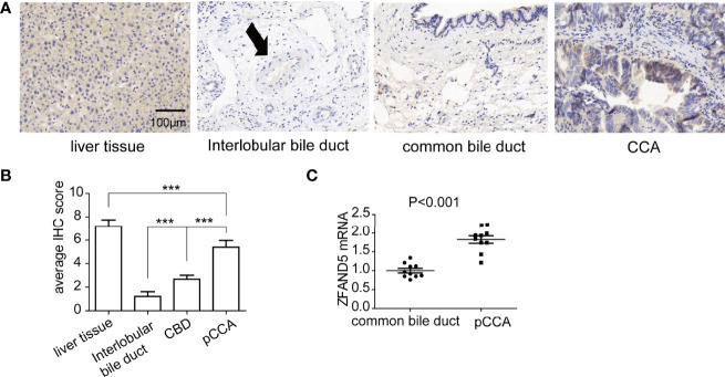 The expressions of ZFAND5 in pCCAs, liver tissues, interlobar bile ducts tissues, and common bile ducts tissues. (A) The expressions of ZFAND5 in pCCAs, liver tissues, interlobar bile ducts tissues, common bile ducts tissues were detected by IHC. Scale bar: 100 μm. The arrow indicates the interlobar bile duct. (B) The expressions of ZFAND5 in pCCAs, liver tissues, interlobar bile ducts tissues, and common bile ducts tissues were estimated by the IHC scores. *** represents P < with one-way ANOVA test. (C) mRNAs of ZFAND5 in pCCAs and common bile ducts were detected with qRT-PCR. The statistical significance was analyzed by paired t test.
