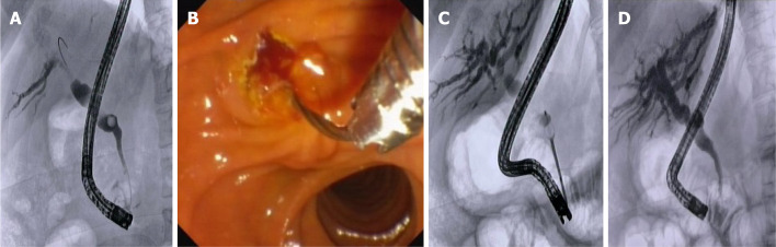 Management of common bile duct stones with distal biliary stricture by mechanical lithotripsy. A: Cholangiogram showing distal common bile duct (CBD) stricture with stone in the medium CBD; B: Introduction of a mechanical lithotripter over the Dormia basket; C: Mechanical lithotripsy under fluoroscopic control; D: Final cholangiogram showing complete CBD clearance.
