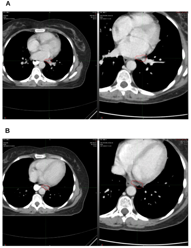 On the left, CT from October 2019, pre-radiation therapy treatment; on the right, CT from June 2022. (A) Hilar lymph node; (B) left para-aortic lymph node. The indicated region highlights the boundary of the treated target.