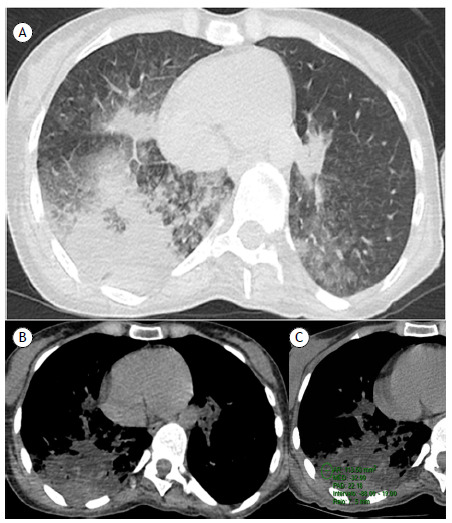 CT scan of the chest at the level of the lower lobe (with lung window settings in A and mediastinal window settings in B and C), showing heterogeneous airspace consolidation with superimposed areas of low attenuation (ranging from −88 to −19 Hounsfield units) in the posterior region of the right lower lobe. This finding is diagnostic of exogenous lipoid pneumonia.