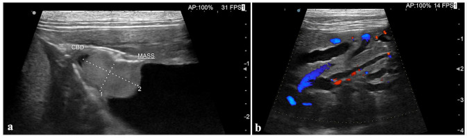 Abdominal ultrasonography: (a) an oval hyperechoic mass distal to the dilated common bile duct (CBD) and (b) dilated intrahepatic bile ducts throughout the liver