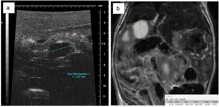 a Measurement of the maximum bile duct diameter of an experimental mouse at 4 weeks of age by abdominal ultrasonography (length = 2.07 mm) b Measurement of the maximum bile duct diameter of an experimental mouse at 5 weeks of age by coronal T2-weighted abdominal MRI (length = 3.579 mm)