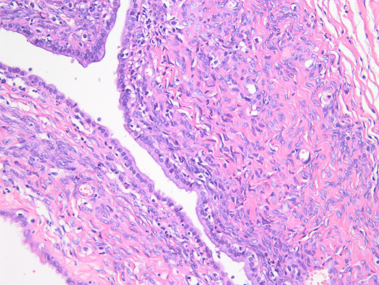 Microscopic examination of the resected specimen showing mucinous cystic neoplasm with low-grade intraepithelial neoplasia.