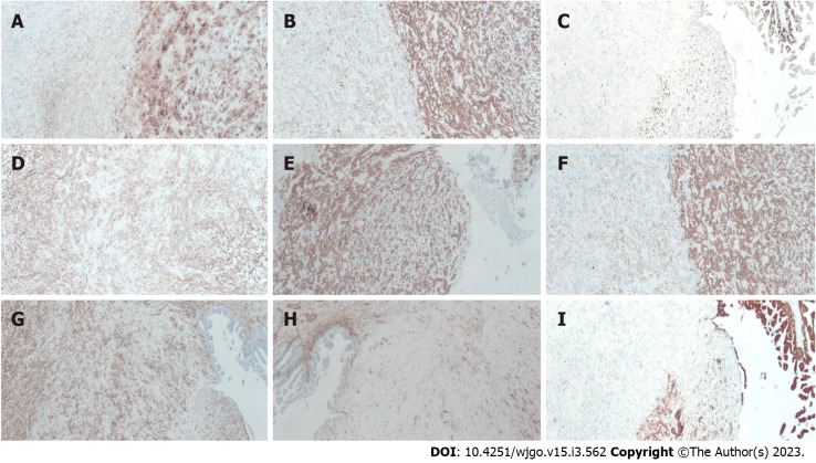 Immunohistochemical examination findings. A: The tissue was positive for carbohydrate antigen 19-9; B: The tissue was positive for CK7; C: Ki-67 was approximately 40%; D: The tissue was positive for Calponin; E: The tissue was positive for CK19; F: The tissue was positive for CKpan; G: The tissue was positive for vimentin; H: The tissue was positive for S-100p; I: The tissue was negative for spinal muscular atrophy.