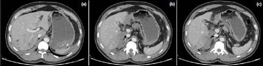 Laceration and contusion areas in the liver parenchyma (a,b) and free fluid with hemorrhagic density around the common bile duct (c).