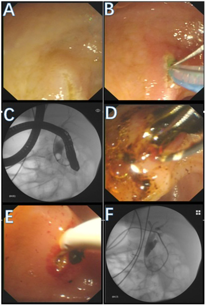 Operation process. (A) The duodenal papilla appeared. (B) An needle knife and a guide wire were used to achieve successful selective biliary cannulation. (C) Under fluoroscopy, cholangiography was performed and showed dilation of the CBD Multiple filling defects were observed in the CBD. (D) A grasping basket was used to remove multiple black stones. (E) A stone retrieval balloon was used to remove the stones in CBD. (F) A drainage catheter was placed at the end of the procedure.