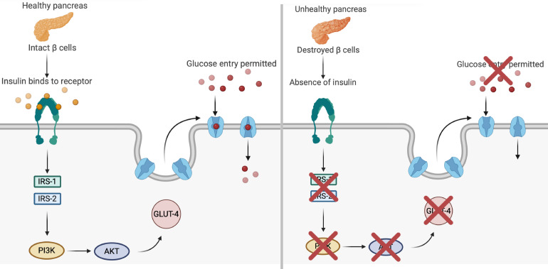 Insulin signaling cascade and glucose transporter type 4 translocation in type 1 diabetes. This figure illustrates the effects of healthy vs impaired pancreatic function on glucose metabolism in type 1 diabetes. In the healthy pancreas (panel A, left), functional β cells secrete insulin, which binds to its receptor on the cell membrane and activates a signaling cascade via insulin receptor substrate 1 (IRS-1) and IRS-2. This triggers the phosphoinositide 3-kinase (PI3K)/protein kinase B (PKB) pathway, promoting the translocation of glucose transporter type 4 (GLUT4) to the membrane and facilitating glucose entry into muscle cells. By contrast, panel B (right) depicts the absence of insulin secretion due to β-cell destruction, which disrupts activation of the IRS-1/IRS-2 and PI3K/PKB pathways. As a result, GLUT4 translocation is impaired, preventing glucose uptake and leading to hyperglycemia. This dysfunction is closely associated with inflammatory and oxidative stress in type 1 diabetes, reinforcing the importance of therapeutic strategies that preserve β-cell function or modulate inflammation.