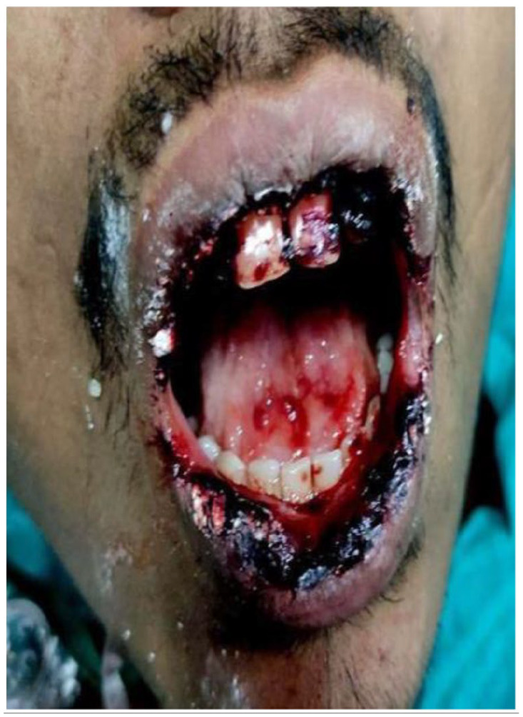 Clinical photograph showing ulceration and sloughing of the oral cavity.