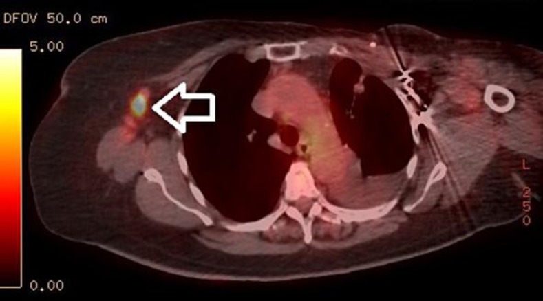 PET demonstrated a lesion in the right axilla. The arrow points at a ‘hot nodule’ found to be metastatic spread of the patient's primary breast cancer.