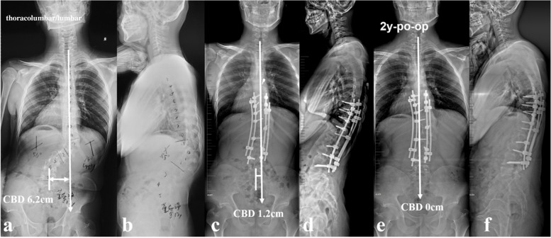 a 17-year-old boy with NF1 related thoracolumbar kyphoscoliosis associated with CCI and vertical straight morphology of upper hemi curve (thoracolumbar type) (a, b). Over correction maneuvers were avoided for main curve. Fine-tuning using concave compression/convex distraction and coronal rod bending in upper hemi-curve was performed to increase the coronal compensation, resulting in opposite tilt of UIV and LIV with similar magnitude (c, d). At 2-year-follow up, the CBD got further improvement to 0 cm (e, f)