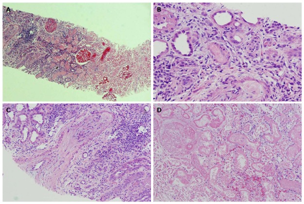 Renal pathology. Pathological findings: A: Corticomedullary junction. The right side is necrotic renal cortex. On the left side of the image there is still viable corticomedullary junction. H and E, × 40; B: An arteriole obliterated with amorphous material (platelet and fibrin thrombus). H and E, × 200; C: An arcuate artery with almost completely obliterated lumen by severe fibrous to mucoid intimal thickening at the corticomedullary junction. H and E, × 100; D: Necrotic renal cortex without nuclear staining in the cells. H and E, × 200.