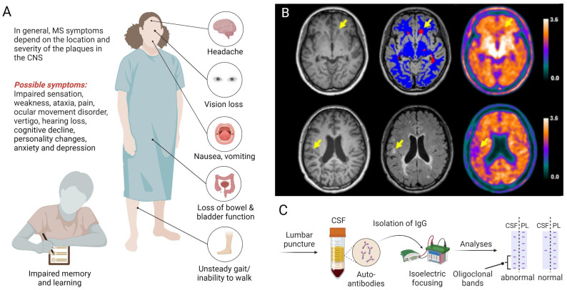 Clinical presentation and biomarker-guided diagnosis of multiple sclerosis (MS). A. The clinical manifestation of MS depends on the location and severity of lesions, involving a myriad of possible symptoms that affect several organs and ultimately lead to disability. B. Diagnostic imaging with T1-weighted (left panel), T2-weighted (middle panel) MRI and 18F-florbetapir PET (right panel) can be used to detect damaged white matter lesions (yellow arrows). Upper and lower rows represent examples from two distinct patients with relapsing-remitting MS according to the revised McDonalds criteria 10. Figure 1B, Adapted with permission from Elsevier, Zhang et al., doi: 10.1016/j.eclinm.2021.100982, copyright 2021. C. The diagnosis of MS is supported by laboratory findings, including the presence of specific oligoclonal bands in the CSF following lumbar puncture. Abbreviations: CSF, cerebrospinal fluid; IgG, immunoglobulin G; MRI, magnetic resonance imaging; PET, positron emission tomography; PL, plasma.