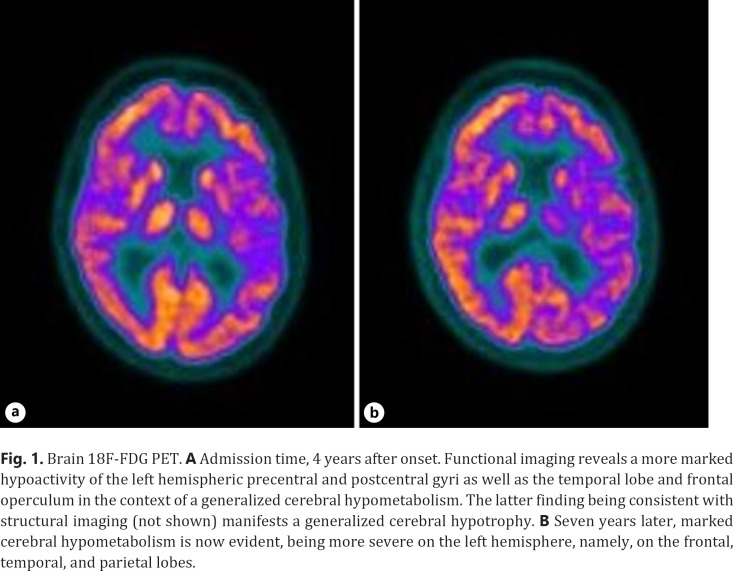Brain 18F-FDG PET. A Admission time, 4 years after onset. Functional imaging reveals a more marked hypoactivity of the left hemispheric precentral and postcentral gyri as well as the temporal lobe and frontal operculum in the context of a generalized cerebral hypometabolism. The latter finding being consistent with structural imaging (not shown) manifests a generalized cerebral hypotrophy. B Seven years later, marked cerebral hypometabolism is now evident, being more severe on the left hemisphere, namely, on the frontal, temporal, and parietal lobes.