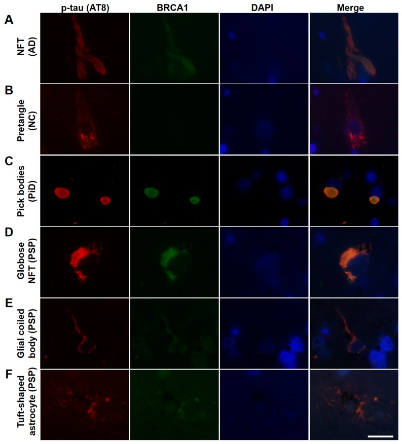 Immunofluorescence double staining of human tauopathy patients’ brains using antibodies against phosphorylated tau (AT8) and BRCA1 (MS110). Colocalization of p-tau and BRCA1 was observed in NFTs of the AD brain samples (A), Pick bodies of the PiD brain samples (C), and globose NFTs (D), glial coiled bodies (E), and some of the tuft-shaped astrocytes in the PSP brain samples (F) but not in the NC brain samples (B). The scale bars represent 20 µm.