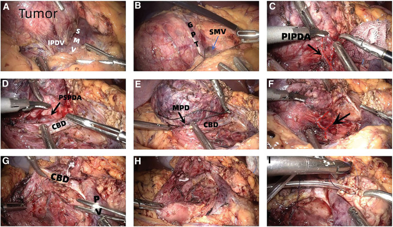 (A) The IPDV flows into the SMV. (B) Suture the GPT. (C) Close to pancreas when free the PIPDA. (D) The PSPDA can be seen behind the CBD. (E) Confirm ampulla and suture the MPD. (F) The posterior pancreatic fascia and the posterior pancreaticoduodenal arterial arch retain their integrity after the total head of the pancreas is removed. (G) There is no residual pancreatic tissue behind the CBD. (H) There was no residual pancreas in the medial duodenum and lateral wall of the CBD. (I) Hong PJ. CBD = common bile duct, GPT = gastric pancreatic trunk, IPDV = inferior pancreaticoduodenal vein, MPD = main pancreatic duct, PJ = pancreaticojejunostomy, PIPDA = posterior inferior pancreaticoduodenal artery, PSPDA = posterior superior pancreaticoduodenal artery, PV = portal vein, SMV = superior mesenteric vein.