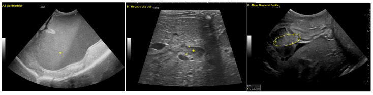 (A) Marked dilation of the gallbladder (*), (B) dilated hepatic bile duct, (+, boarders marked with 1 and +) and (C) thickened major duodenal papilla (oval, boarders of papilla marked with +, 1 and 2).