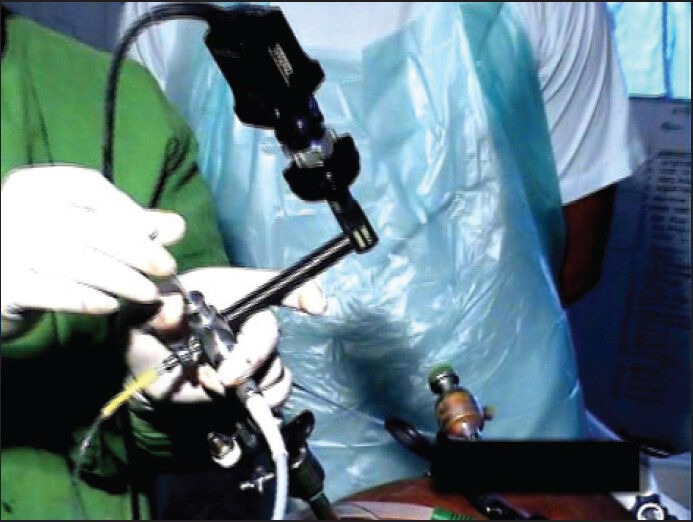 Rigid tubal ligation scope is inserted through the umbilical port