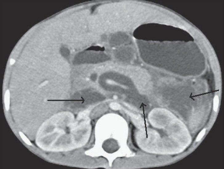 Transaxial contrast-enhanced CT scan shows a dilated intrapancreatic CBD, and a fluid collection in front of the great vessels and in the anterior left pararenal spaces (black arrows) with a pseudowall on the left