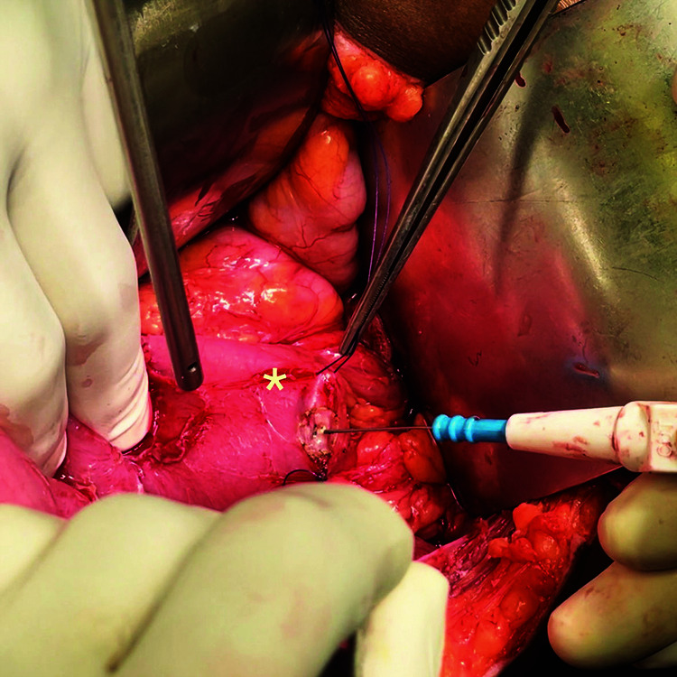 Image depicting the duodenotomy after taking stay sutures over the second part of duodenum after adequate kocherization; (* = second part of duodenum)