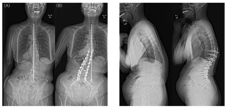 Preoperative and postoperative standing radiographs showing worsened CM after surgery in a 75-year-old woman with type 2 CM. CBD worsened from 38.1 mm preoperatively (A) to 67.7 mm postoperatively (B), with the C7 plumb line on the same side as the CBD. Sagittal alignment improved, but proximal junctional kyphosis was noted postoperatively.