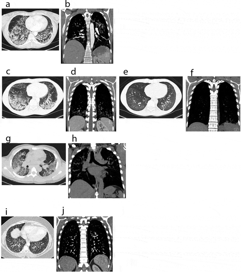 CT scans: computerized tomography of chest, showing a spectrum of EVALI in axial and coronal views. (a, b) Chest CT images of case 1 on admission, pre-treatment. (a) revealed bilateral ground glass opacities and interstitial infiltrates. (b) revealed prominent right hilar lymph nodes and an enlarged intrathoracic node. (c–f) Chest CT images of case 2. (c, d) (on admission, pre-treatment) demonstrating bilateral ground glass infiltrates. (e, f) (steroid day 4) showing significant improvement of lung infiltrates bilaterally. (g, h) Chest CT images of case 3 on admission, pre-treatment. (g) demonstrating diffuse patchy ground-glass opacities bilaterally. (h) showing mediastinal lymphadenopathy and interstitial infiltrates bilaterally. (i, j) Chest CT images of an asymptomatic patient with vaping history. CT images showed mild diffuse ground-glass opacities bilaterally