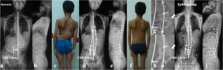 a 14-year-old boy with NF1 related lumbar kyphoscoliosis associated with CCI and dystrophic vertebral rotatory subluxation at L2/3 & L3/4 levels (lumbar type) (a, b and c). Stage 1 posterior spinal correction and fusion surgery was performed with low screw density yet with generous posterior fusion, followed by stage 2 supplementary anterior intervertebral fusion utilizing autogenous rib grafts (d, e, g). The coronal balance was well reconstructed despite low correction rate of main curve (d, f). 2.25-year-follow up revealed satisfying intervertebral fusion (h) and well maintenance of coronal balance with no instrumentation failure (i, j)