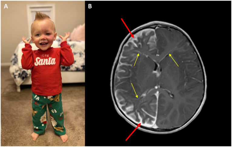 (A) Image of a SWS patient with a left facial port-wine birthmark and (B) corresponding T1 post-contrast MRI indicating leptomeningeal involvement and abnormal blood vessels, indicated by red arrows. Yellow arrows indicate enlarged deep veins that flow into the cortex.