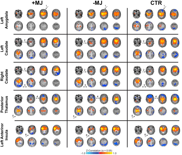 Neonatal functional connectivity and prenatal marijuana exposure. Functional connectivity for different seed regions (top to bottom) and infant groups (left to right): marijuana positive (+MJ) with or without in utero exposure to alcohol, nicotine, SSRIs, and opiates; infants with in utero exposure to some combination of the aforesaid drugs minus marijuana (−MJ); and age-matched drug-free controls (CTR). Data threshold set using the combined approach: α = 0.05: voxel-wise p ≤ 0.01, cluster size = 32 voxels. Pseudo-coloring (see color bar at bottom) is based on Fisher’s Z-transformation of the temporal correlation between each voxel and the seed region. Data visualized in the axial view on a subset of high-resolution T1-weighted reference images.