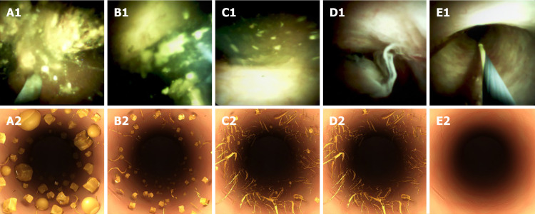 SpyGlass DS images and simulation graphs of the residual stone. A-E: SpyGlass DS images (A1-E1) and simulation graphs (A2-E2). Score 1: A large amount of stone fragments and biliary sludge. Score 2: A moderate amount of stone fragments and biliary sludge. Score 3: A small amount of stone fragments and biliary sludge. Score 4: Presence of biliary sludge without any stones. Score 5: Completely cleared common bile duct without any biliary sludge.
