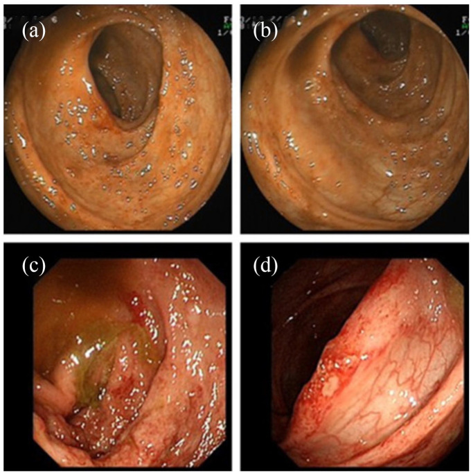 Twice colonoscopy showed segmental inflammation and shallow ulcers from distal ileum to sigmoid colon.