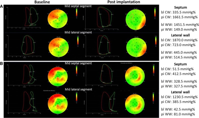 Changes in regional left ventricular myocardial work in responder (A) and non-responder (B) to cardiac resynchronization therapy. The pressure-strain loops are shown for the global left ventricular (LV) cardiac constructive work (CW) (in red) and for the indicated segments (in green). In the responder patient (A), after implantation of cardiac resynchronization therapy there is an increase in the LV CW and this is achieved by significant improvement in CW of the mid septal segment and normalization of the CW of the mid lateral segment. In the non-responder patient (B), the CW of the mid septal segment improves but the lateral wall remains impaired resulting in reduced LV CW. Reproduced with permission from Kostyukevich et al8bl, baseline; pi, post-implantation; WW, wasted work