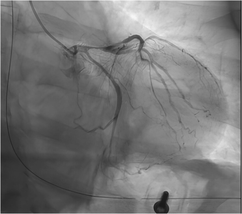 Left coronary angiography showing spontaneous vasospasm at the ostium and proximal segments of the left anterior descending and circumflex artery.