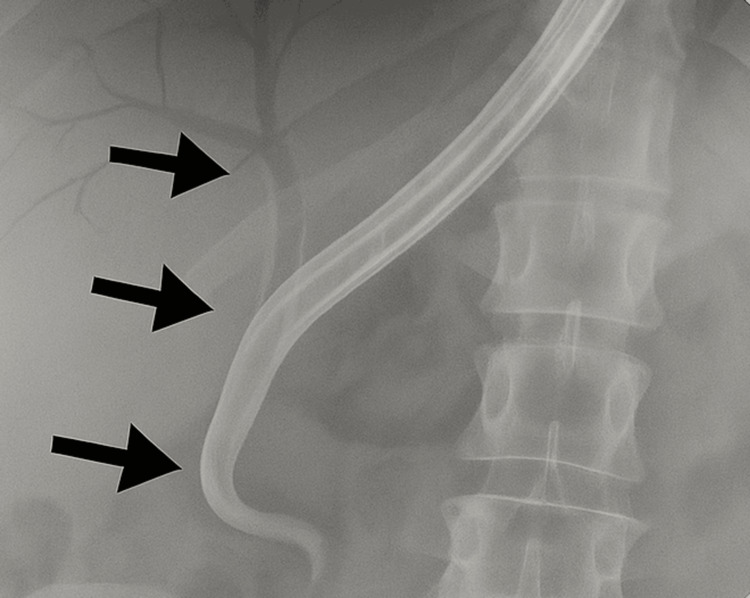 Cholangiogram showing the placement of a metallic stent in the biliary tractThe black arrows show the placement of a stent in the biliary tract with its dilation up the ampulla.