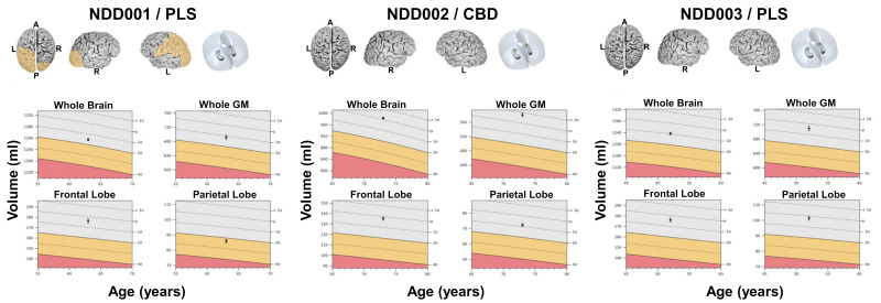 The anatomical three-dimensional (3D) T1-weighted images in three patients with neurodegenerative diseases (NDDs; primary lateral sclerosis [PLS] for NDD001, corticobasal degeneration [CBD] for NDD002, and PLS for NDD003) were processed for global and regional brain volumetric assessment, indicating deviations from normal volumetry versus a heterogeneous database (in ml, considering age, sex, and intracranial volume). Results for volumetric assessment are shown for the whole brain, whole gray matter (GM), frontal lobe, and parietal lobe. Orange color indicates reduced volumes (−2σ), and red color indicates severely reduced volumes (−4σ). A—Anterior, P—Posterior, L—Left, R—Right for the brain templates, GM—Gray matter.
