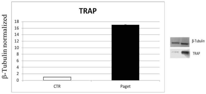 Comparison of the expression of the TRAP enzyme between OCs of 2 subjects with PDB and 2 healthy ones. The most representative images are displayed. The relative quantification for TRAP expression normalized for the housekeeping protein β-Tubulin is presented in histograms as the mean ± SD of independent experiments of each individual sample.