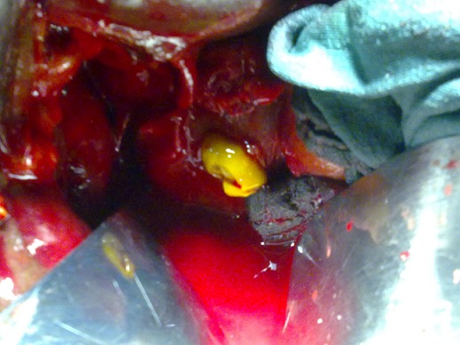 Operative view showing a hydatid materiel of CBD after choledochotomy