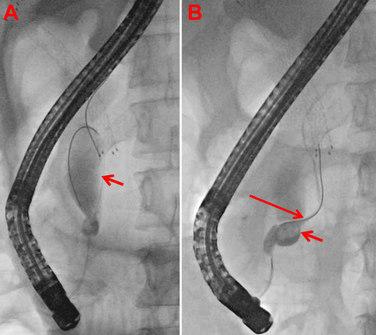 Imaging during endoscopic retrograde cholangiopancreatography.(A) The arrow indicates the elongated residual common bile duct. (B) The long arrow indicates a P-B-type anomalous pancreaticobiliary ductal union (APBDU), and the short arrow indicates the formation of stones at the confluence of the bile and pancreatic ducts.