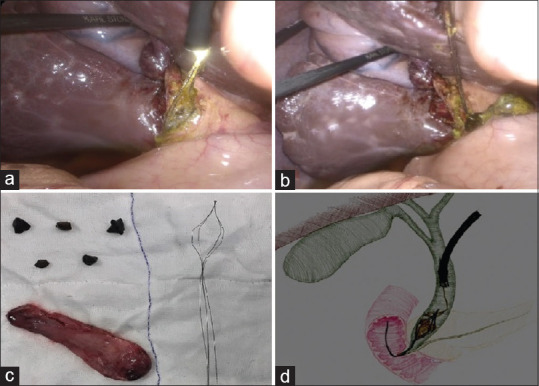 (a and b) Intra-operative picture of laparoscopic common bile duct exploration and retrieval of dormia and calculi; (c) post-operative image of specimen (gallbladder, common bile duct calculi and basket); (d) schematic presentation of 'dormia with dormia technique'