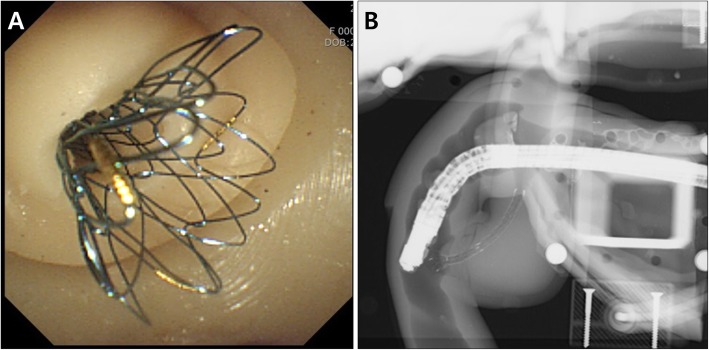 Biliary metal stent insertion using distal stricture and proximal dilation of the CBD module (a Endoscopic view; b Fluoroscopic view)