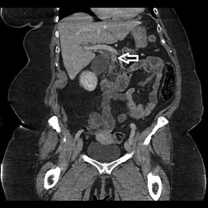CT of the abdomen and pelvis demonstrated a mass in the CBD with no liver involvement. The arrow points at metastatic breast cancer in the CBD, with dilation of the CBD distal to the mass.