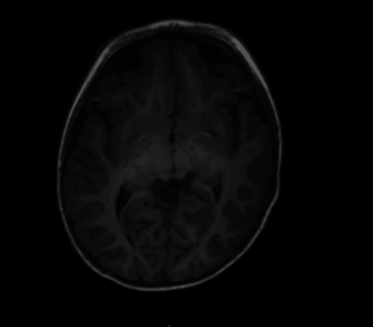 Axial T1-weighted magnetic resonance imaging (MRI) of the brain demonstrating no acute infarction, mass effect, hemorrhage, or structural abnormalities. The temporal lobes are unremarkable.