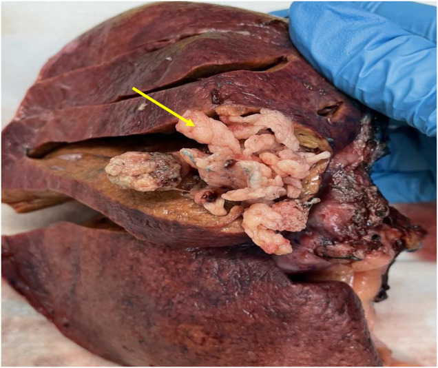 Gross pathology image.