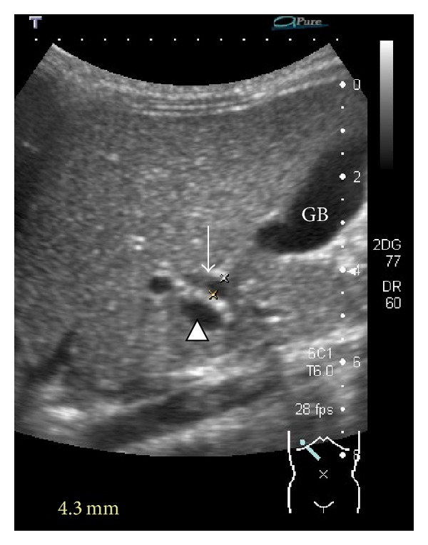 Common bile duct dilatation on ultrasound (arrow). The duct is measured as 4.3 mm. Portal vein (arrowhead). GB: gallbladder.