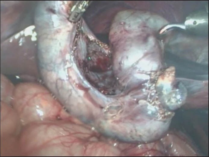 Two lobes of gallbladder attached at their neck
