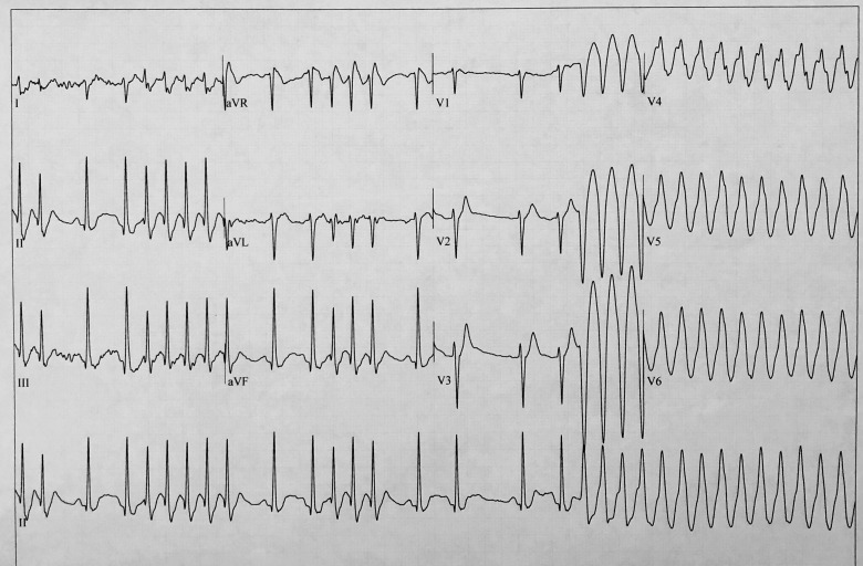 Patient 1: Exercise test, recovery phase. Conversion of atrial fibrillation to sustained monomorphic ventricular tachycardia.